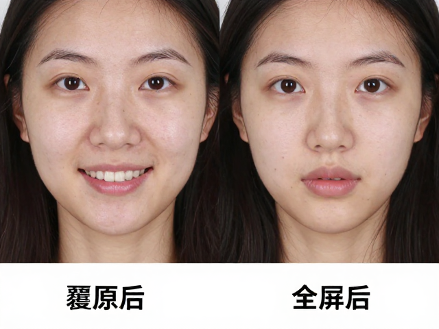 覆颌与覆盖异常对美学特征的具体影响