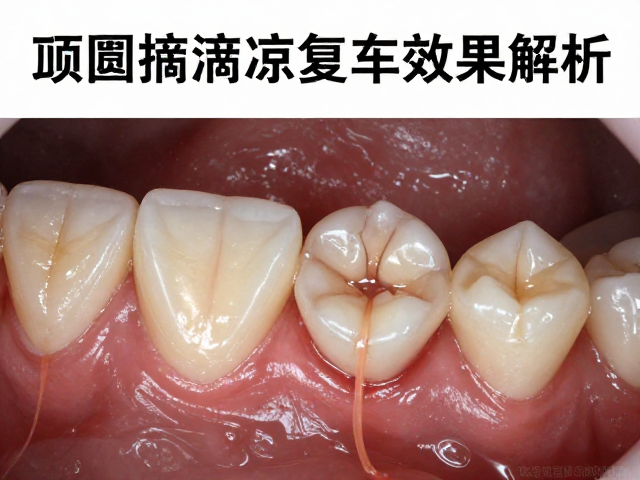 牙髓摘除后做嵌体修复，临床病例积累与修复效果解析