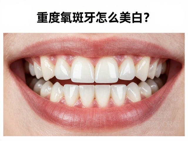 牙齿上釉(贴面)修复的核心逻辑