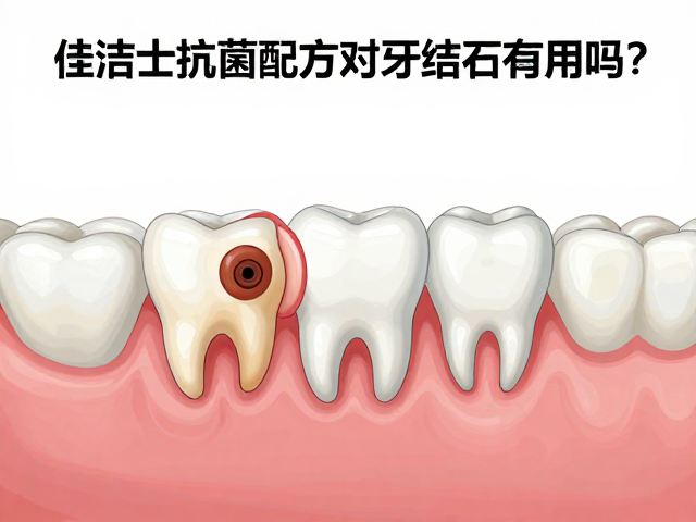佳洁士抗菌配方对牙结石有用吗?深入解析牙结石形成与预防