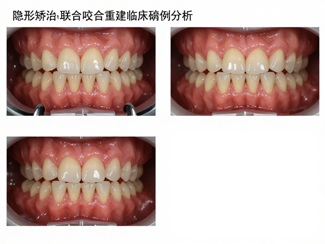 咬合功能的重建与生物力学平衡