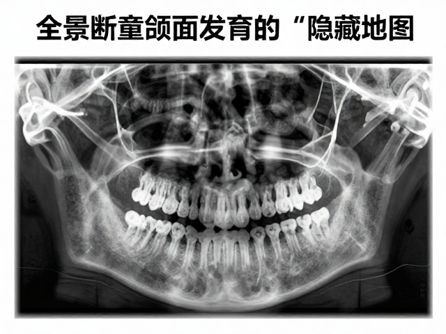 儿童牙齿排列不齐?全景断层扫描看发育报告,早发现早矫正