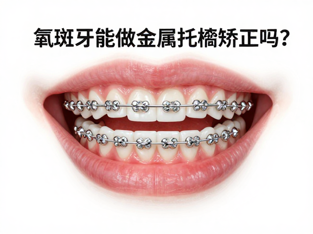 针对氟斑牙的金属托槽矫正方案解析