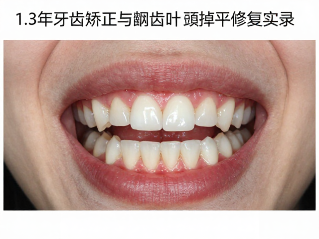 1-3年牙齿矫正与龋齿治疗案例分享，种植牙修复实录