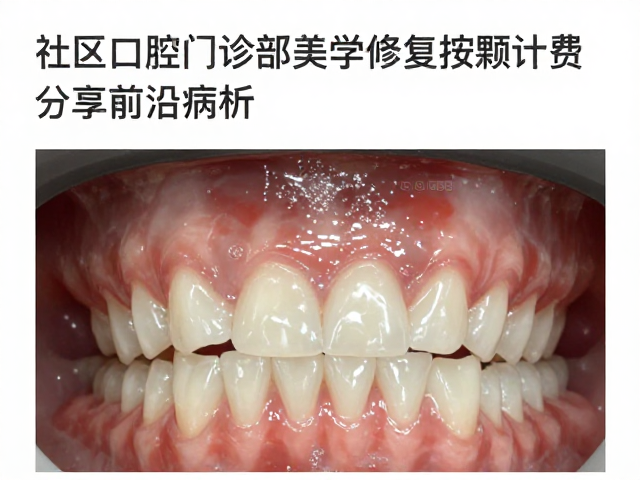 社区口腔门诊部美学修复按颗计费,分享学术会议前沿病例