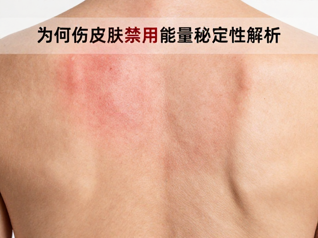 晒伤皮肤禁用光电治疗的病理生理基础