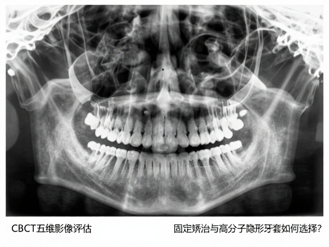 CBCT三维影像评估,固定矫治与高分子隐形牙套如何选择?