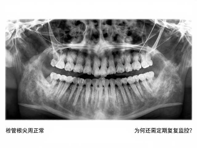 前牙根管治疗后X线根尖周正常,为何还需定期复查监控?
