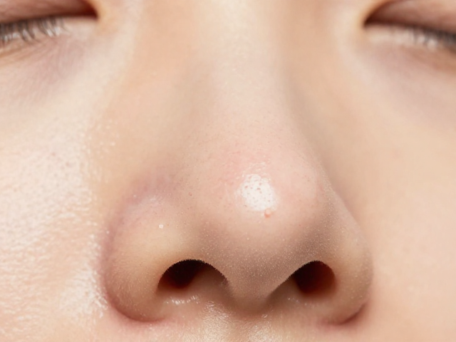 物理吸出黑头靠谱吗？黑头导出，粉刺护理全攻略，告别草莓鼻