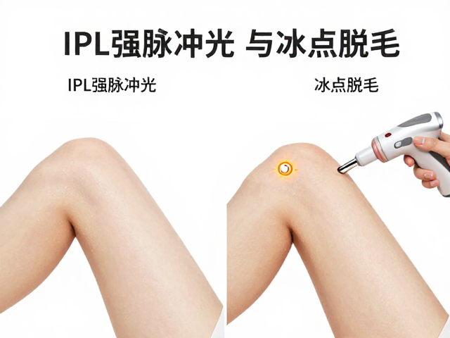 IPL强脉冲光与冰点脱毛区别，揭秘选择性光热作用原理