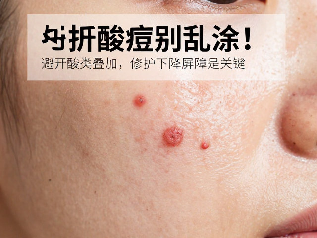 酸类叠加使用对皮肤屏障的二次伤害