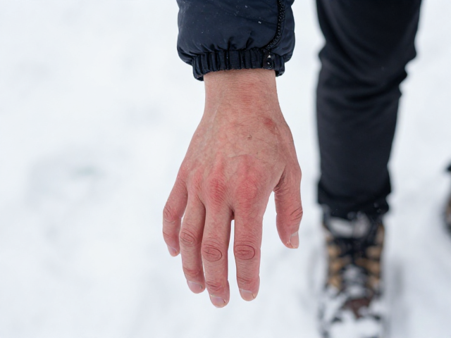 雪地漫步手部冻伤?抗寒贴片护指关节,温暖防冻攻略