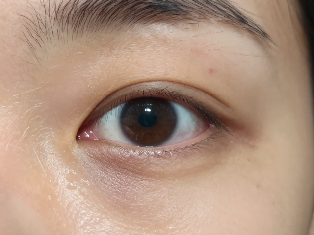 鱼腐皮病怎么治?眼睛浑浊肿胀需定期健康检查