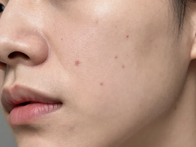 痘痘爆发期怎么救?清爽不黏腻补水控油面膜实测
